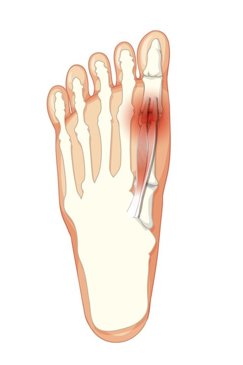 схема шишка на большом пальце ноги