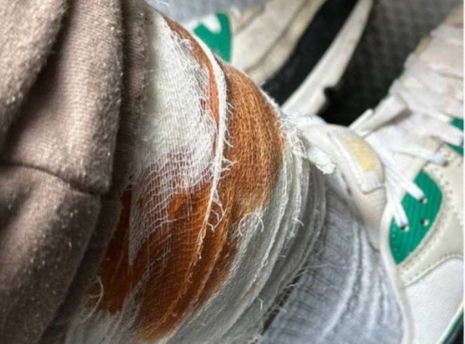 Собачий укус