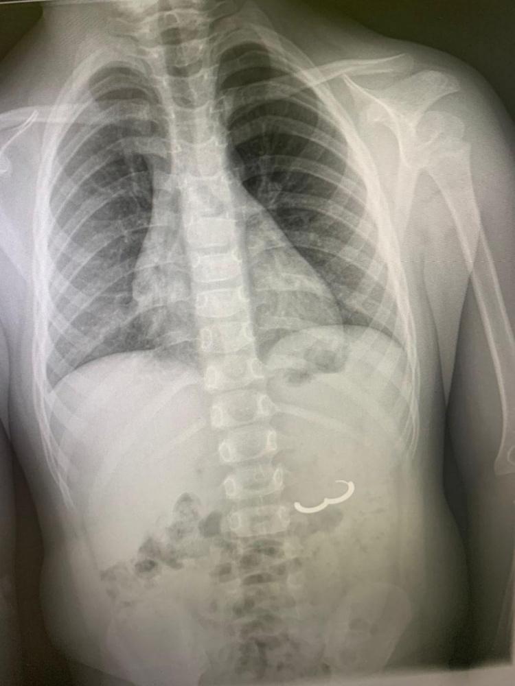 В Туапсе врачи извлекли золотую серьгу из желудка 4-летнего ребёнка