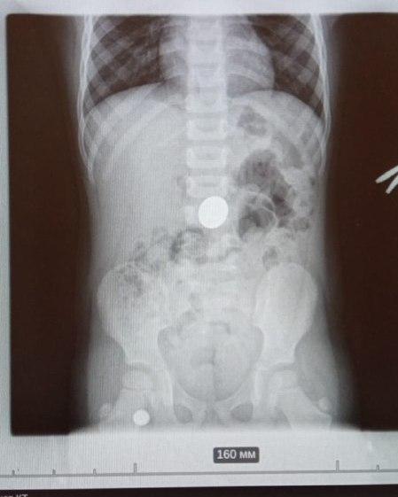 Туапсинские врачи вытащили из желудка 4-летнего ребенка пятирублевую монету