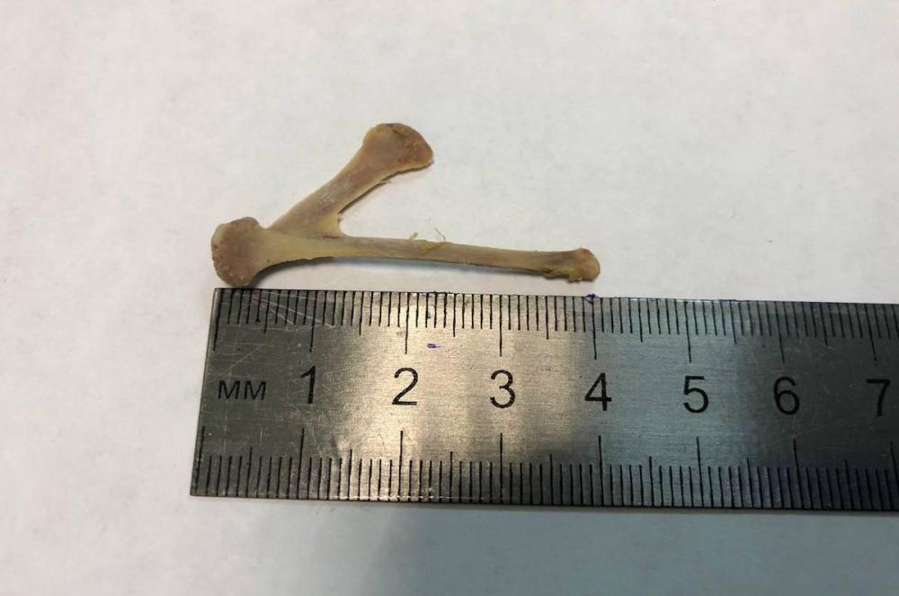 Новороссийские врачи извлекли из пищевода ребенка большую куриную кость
