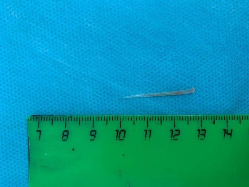 В Туапсе врачи вытащили из горла пациентки 3-сантиметровую рыбью кость