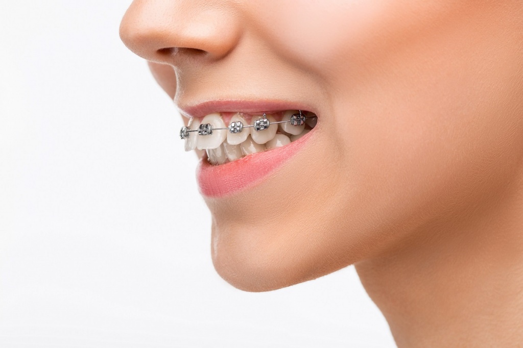 beautiful-young-woman-with-teeth-braces.jpg beautiful-young-woman-with-teeth-braces.jpg