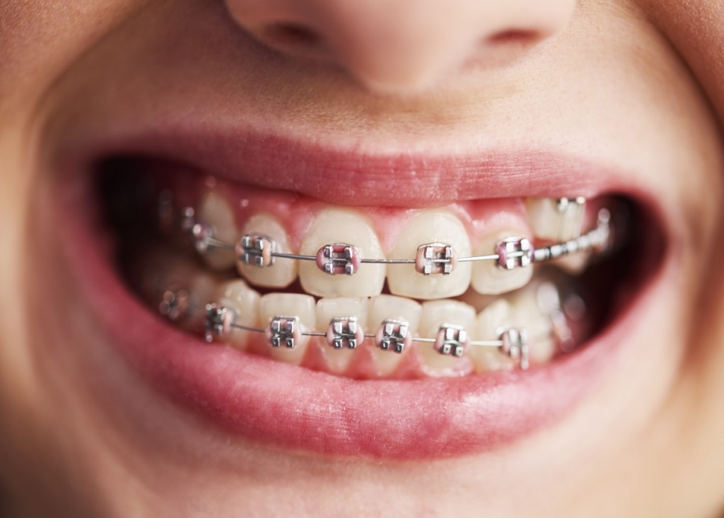shot-child-s-teeth-with-braces.jpg
