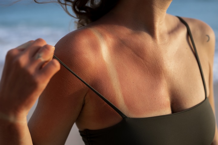 details-woman-s-sunburn-skin-from-beach-sun.jpg Молодая женщина с солнечным ожогом